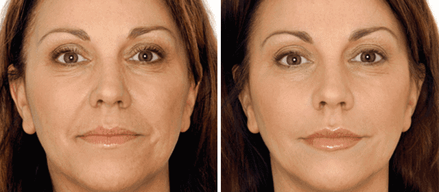 Vampire-Facial-Before-and-After-Photo skin rejuvenation bend oregon
