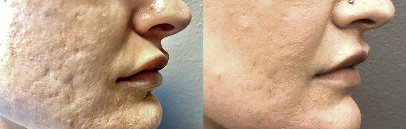 venus-viva-patient-4-face-img