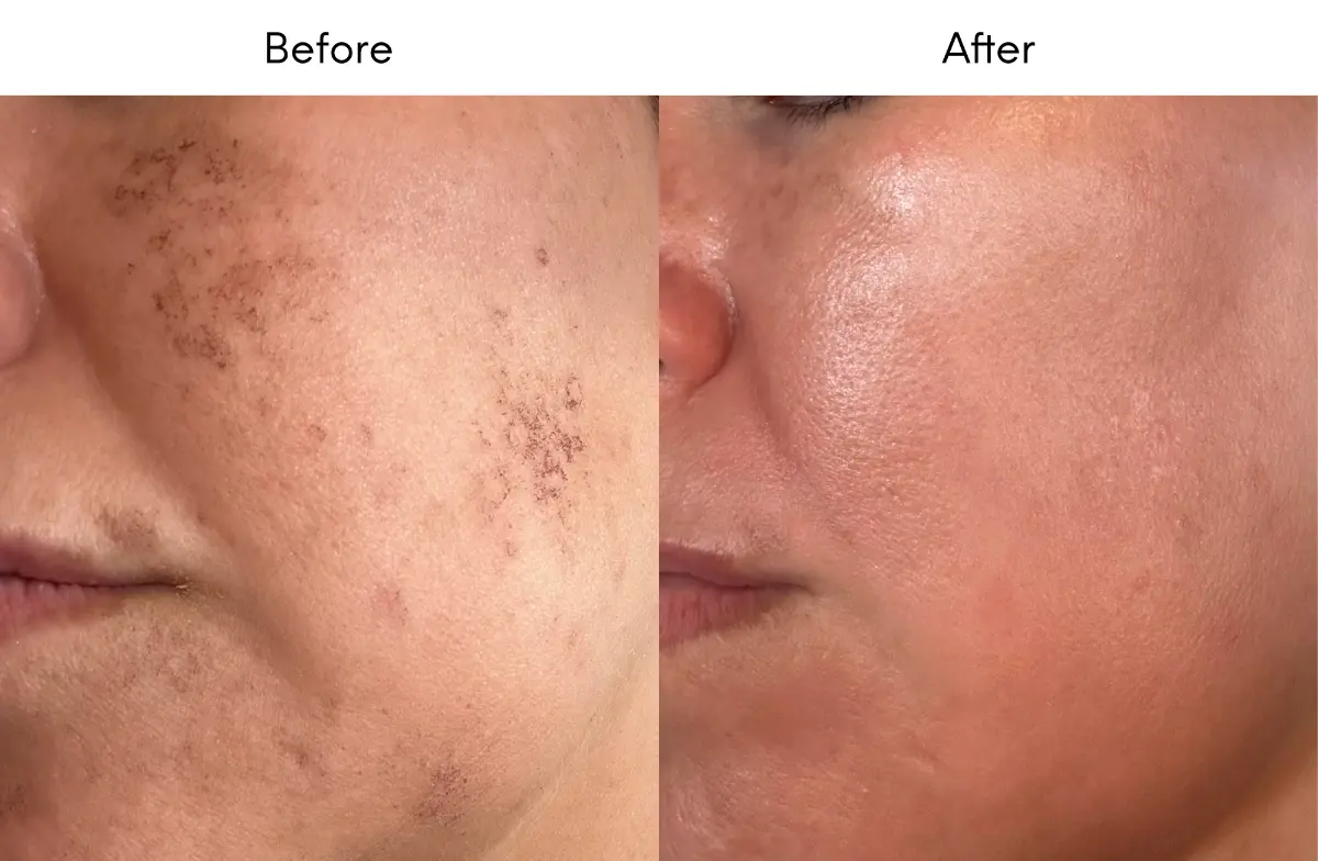 Before and After