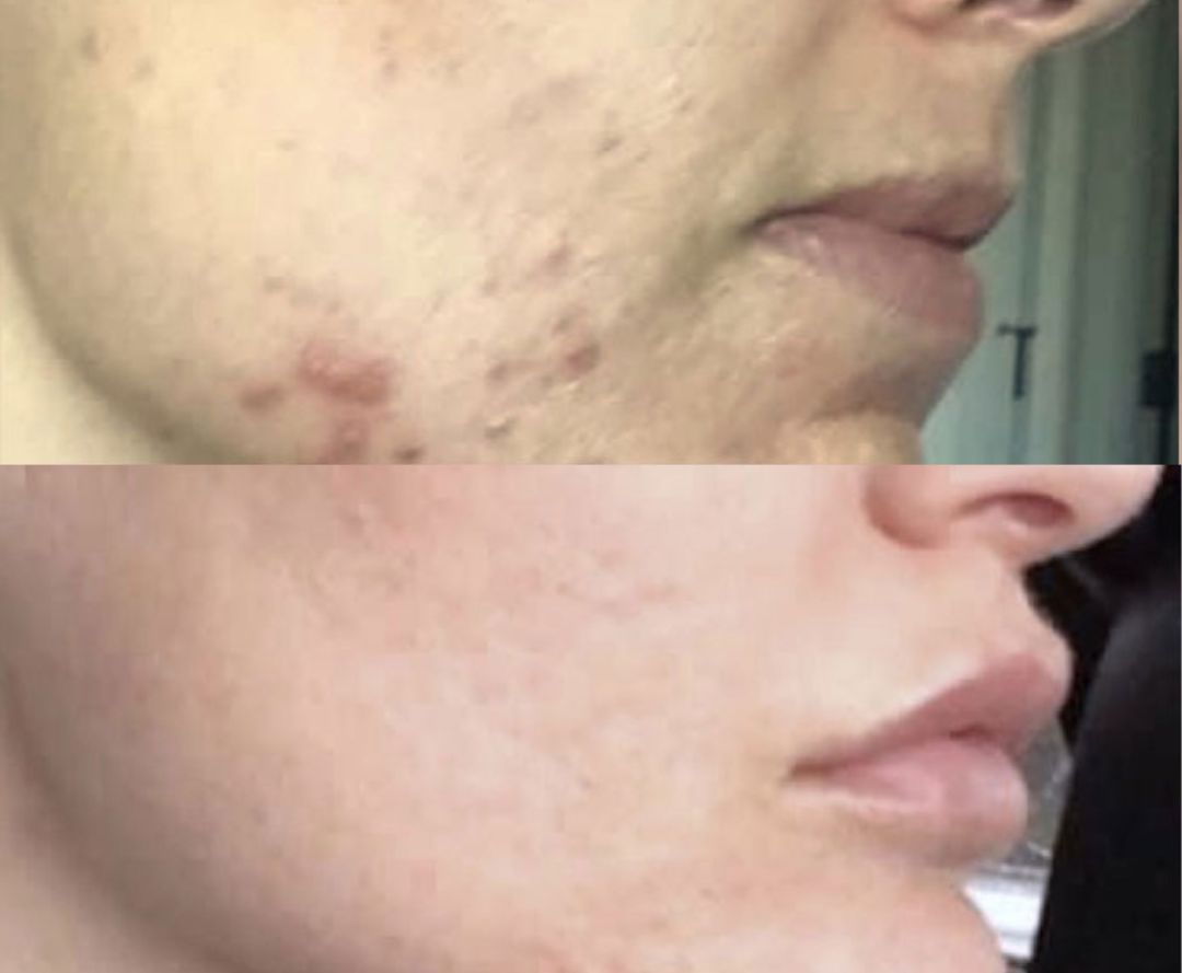 Before and After treatment of Venus Viva on acne scars
