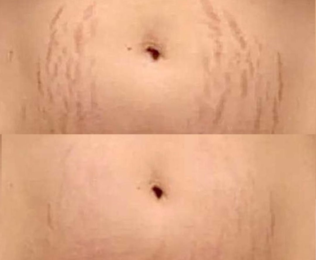 before and after of venus viva treatment on stretch marks