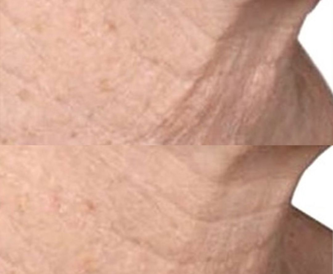 before and after of venus viva treatment on neck