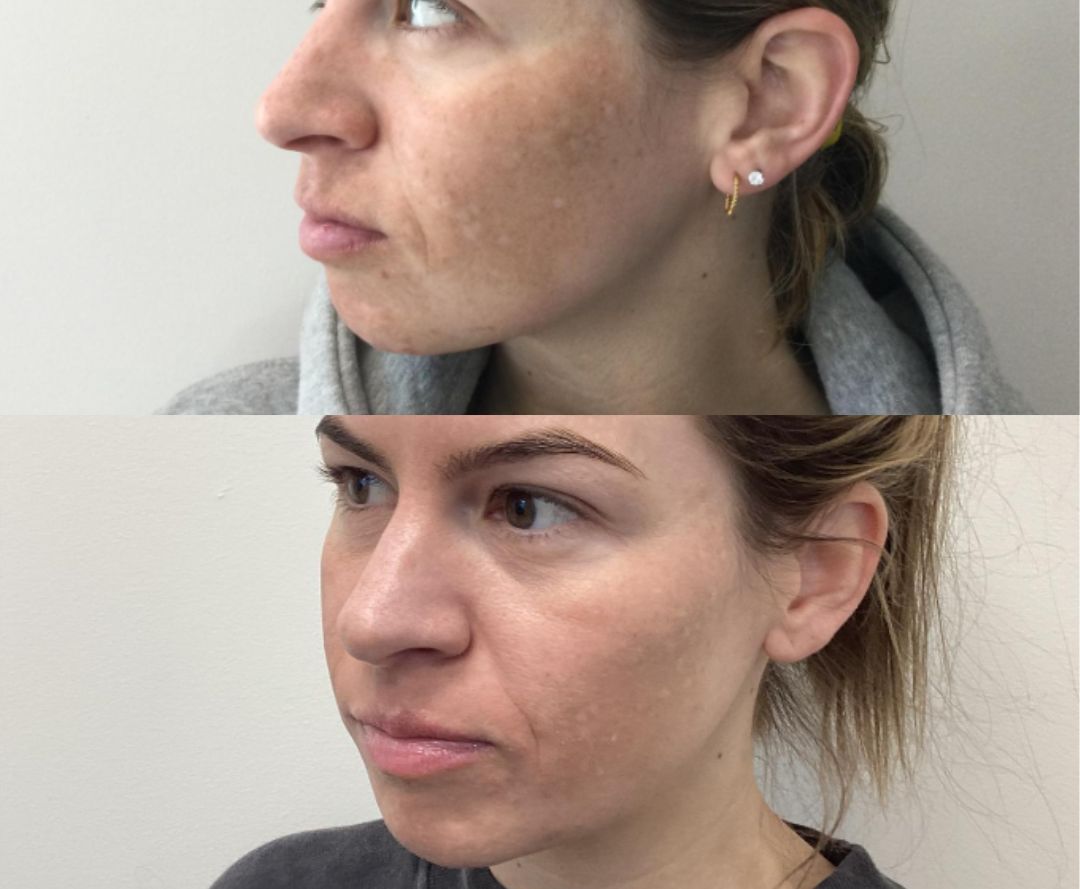 before and after images of a woman with PRP microneedling treatment