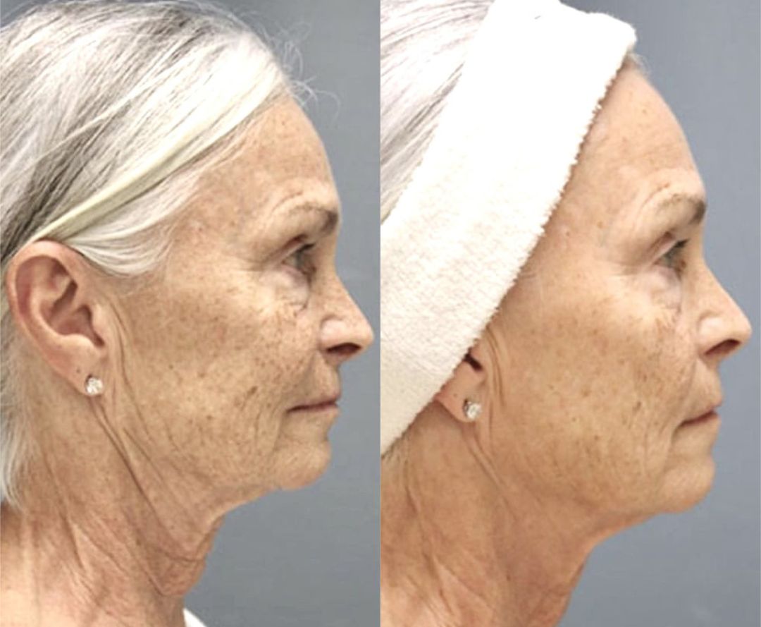 Pixel8-rf before and after image of woman