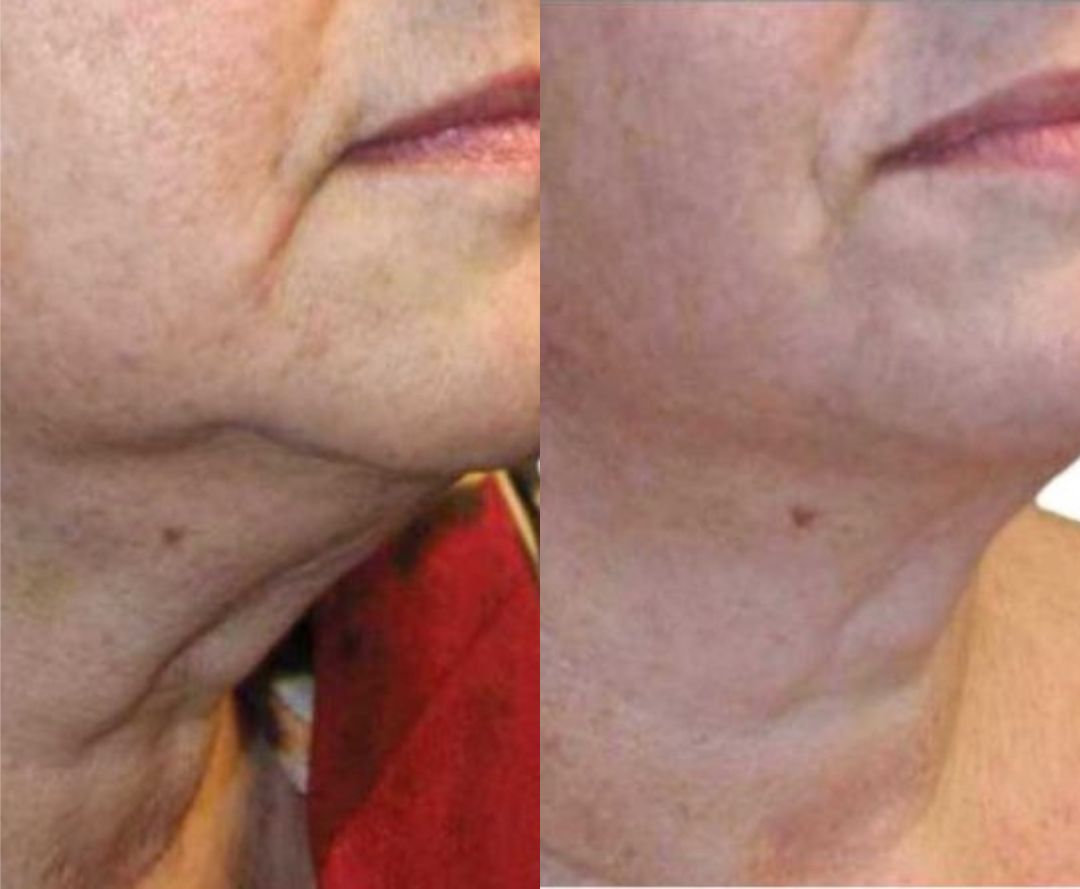 before and after pixel8-rf treatments on neck, jaw, and chin