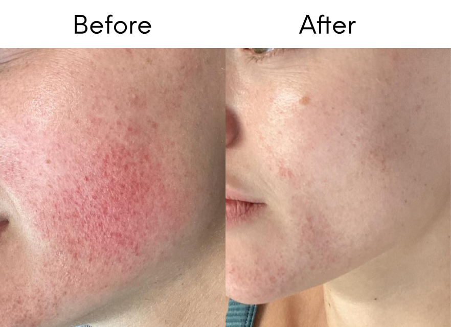 rosacea treatment bend - 001 rosacea treatment bend