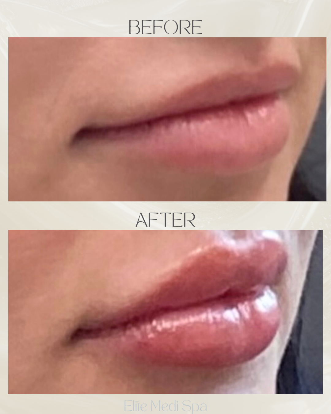 injectable lip filler before and after