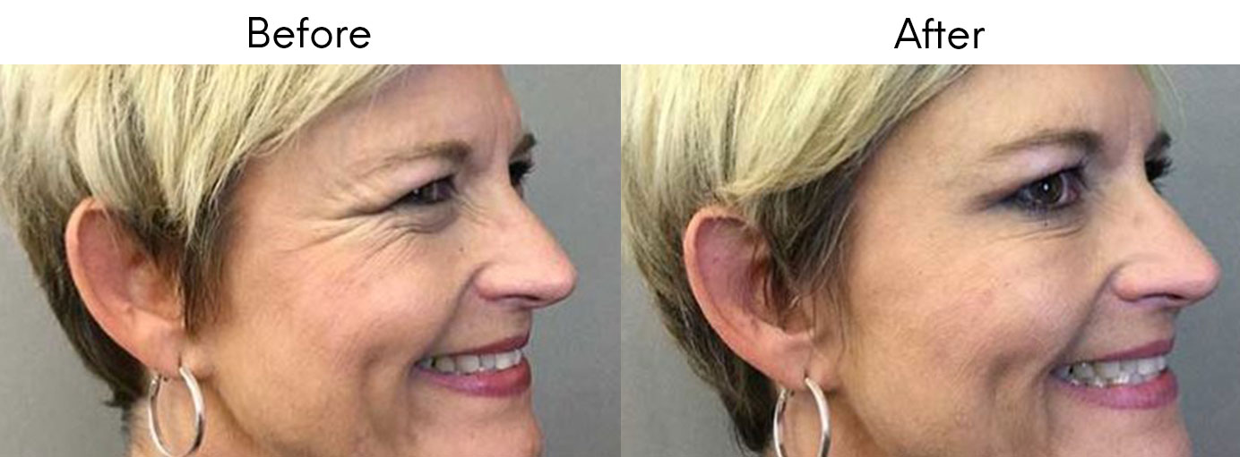injectable filler and botox for face