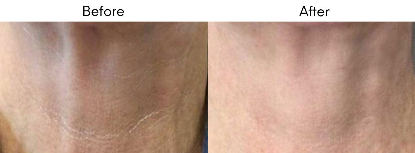 injectables for neck wrinkles
